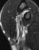 MRI Biceps Partial Tear